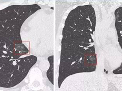 Precision 32 精密断层能谱CT在新冠肺炎影像学检查中的优势